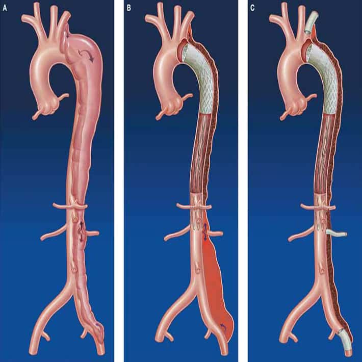 An Aortic Dissection