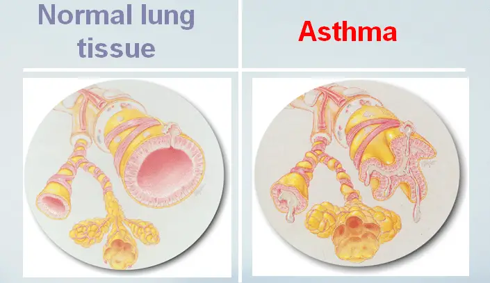 Asthma Nursing Diagnosis
