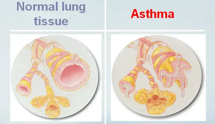 Asthma, Diagnosis of Asthma, Treatment for Asthma, and 5 Asthma Nursing Care Plan Examples