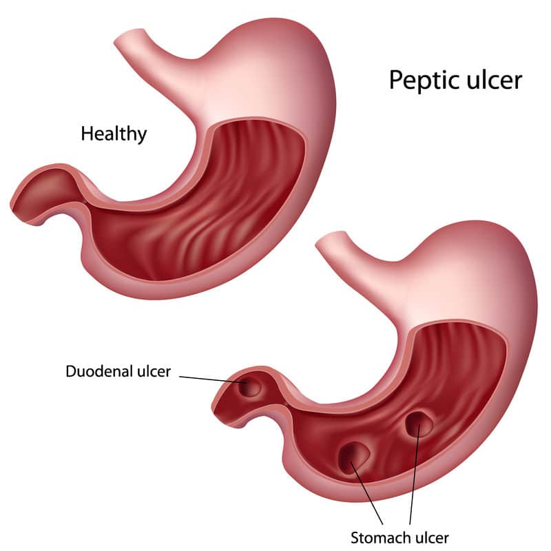 Peptic Ulcer Disease