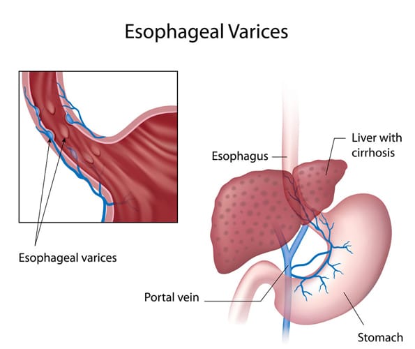 esophageal varices