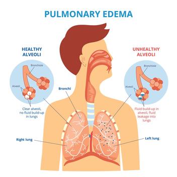 Pulmonary Edema Nursing Diagnosis and Nursing Care Plan 