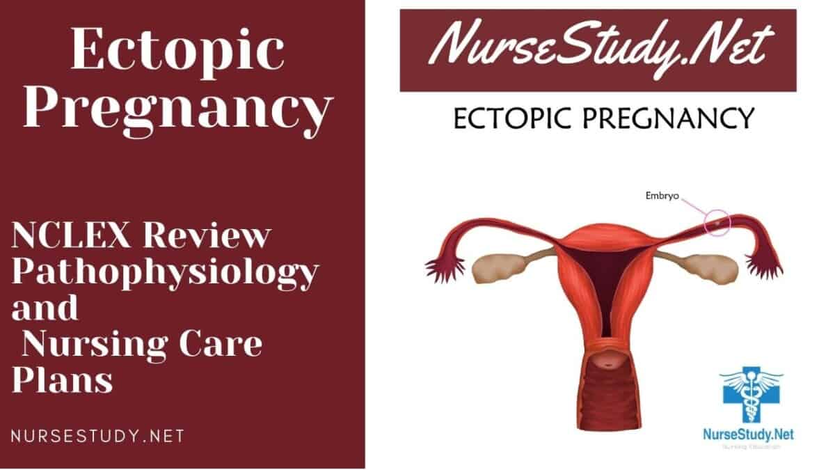 nursing diagnosis for ectopic pregnancy