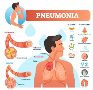 Understand a Diagnosis of Pneumonia