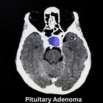 Pituitary Adenoma